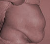 Body reshaping surgery in Chandigarh