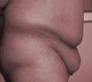 Body reshaping surgery in India