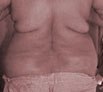 Body reshaping surgery in Punjab