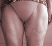 Body reshaping surgery in Chandigarh