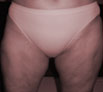 Body reshaping surgery in India
