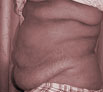 Body reshaping surgery in Punjab