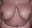 Breast Reduction Treatment Chandigarh