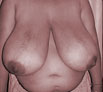 Breast Reduction Treatment Punjab