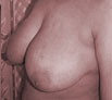 Breast Reduction Treatment India