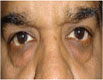 Eyelid surgery in India