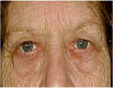 Eyelid surgery in Punjab