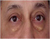 Eyelid surgery in Chandigarh