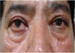 Eyelid surgery in India