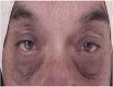 Eyelid surgery in Punjab