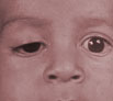 Eyelid Surgery Ptosis Surgery in Chandigarh
