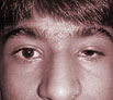 Eyelid Surgery Ptosis Surgery in Punjab