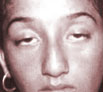 Eyelid Surgery Ptosis Surgery in India