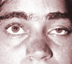 Eyelid Surgery Ptosis Surgery in Punjab