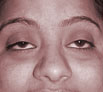 Eyelid Surgery Ptosis Surgery in India