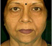 facial reconstruction surgery in Chandigarh