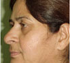 facial reconstruction surgery in India