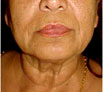 facial reconstruction surgery in Chandigarh