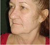 facial reconstruction surgery in India