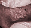 Leg trauma treatment in India