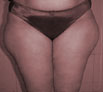 Liposuction treatment in India
