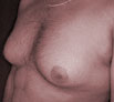 Liposuction treatment in Punjab
