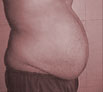 Liposuction treatment in Chandigarh