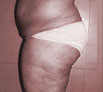 Liposuction treatment in India