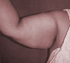 Liposuction treatment in Punjab