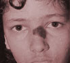 Birth defects treatment in India