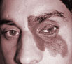 Birth defects treatment in Chandigarh