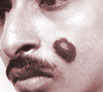 Birth defects treatment in Punjab