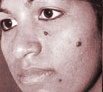 Birth defects treatment in Chandigarh