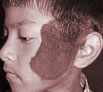 Birth defects treatment in India