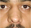Nose Reshaping in Chandigarh