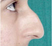Nose Reshaping in India