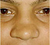 Nose Reshaping in Punjab