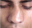 Nose Reshaping in Chandigarh