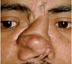Nose Reshaping in India