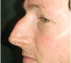 Nose Reshaping in Punjab