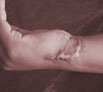 Face Scar Revision in Punjab