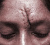 Face Scar Revision in Chandigarh