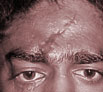 Face Scar Revision in India