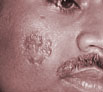 Face Scar Revision in Punjab