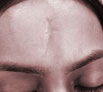 Face Scar Revision in Chandigarh