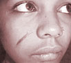 Face Scar Revision in India