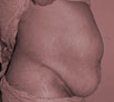 Tummy Tuck in Chandigarh