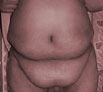 Tummy Tuck in Punjab