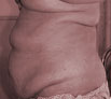 Tummy Tuck in India