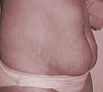 Tummy Tuck in Chandigarh